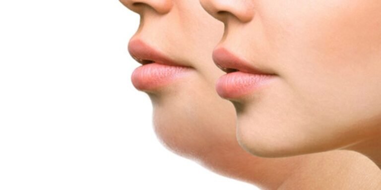 غبغب ارثی یا ناشی از سبک زندگی؟ بهترین روش رفع چربی زیر چانه چیست؟