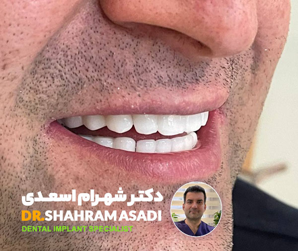 ایمپلنت دندان