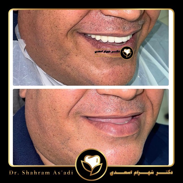 هزینه ایمپلنت دندان