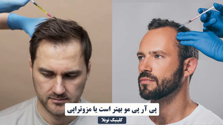 پی آر پی مو بهتر است یا مزوتراپی (توضیحات پزشک)