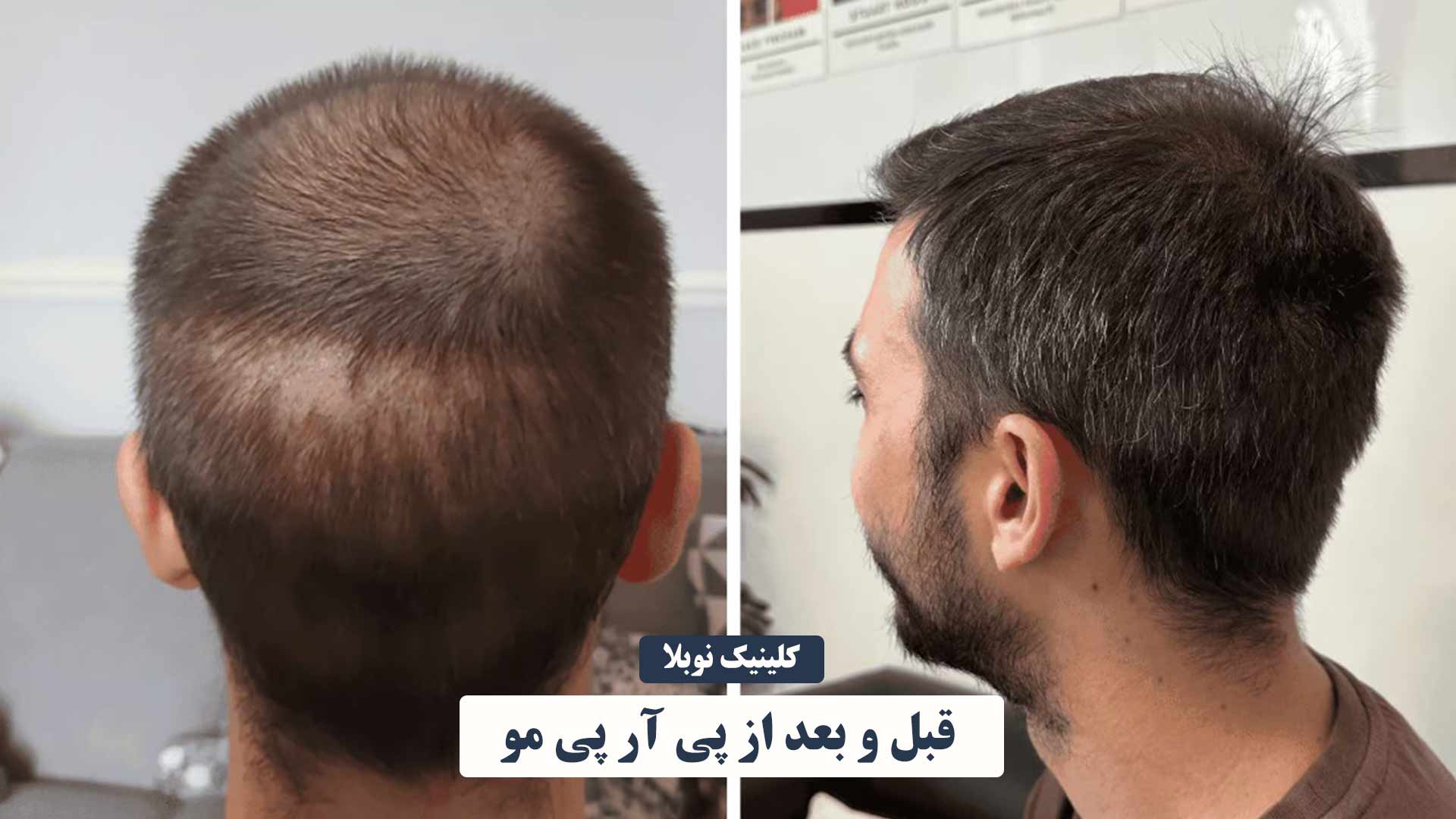 قبل و بعد از پی آر پی مو