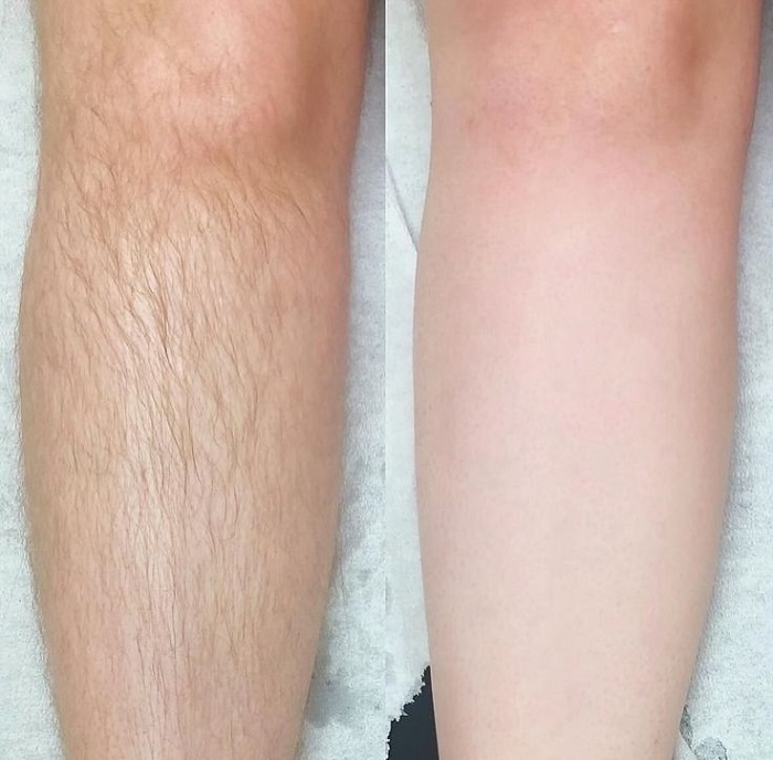 فرآیند انجام لیزر موهای زائد زیر نظ اپراتور متخصص